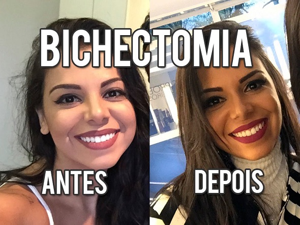 bichectomia-2