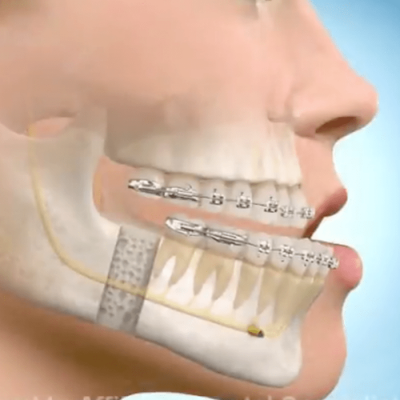 cirurgia-ortognatica-min